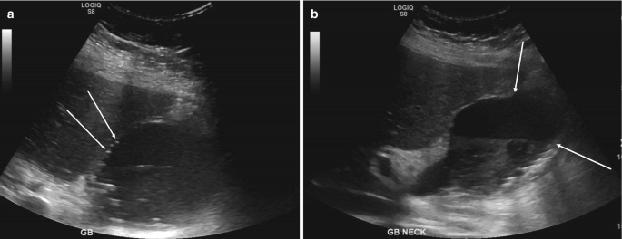 An ultrasound scan image of gangrenous cholecystitis a and b. a. G B image with some portions darkly shaded is indicated with the two parallel arrows. b. G B neck, some darkly shaded portion is indicated with the two opposite arrows.