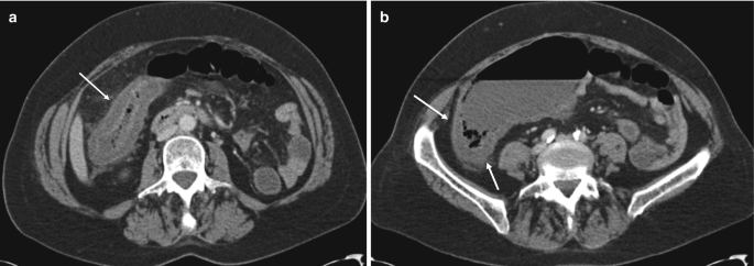 A set of 2 C T images for neutropenic colitis. The dome-shaped structure a. light shaded portion at the middle with one arrow, b. Two light-shaded rod-like structures at the ends, and a circle-shaped structure at the center with two arrows are indicated.