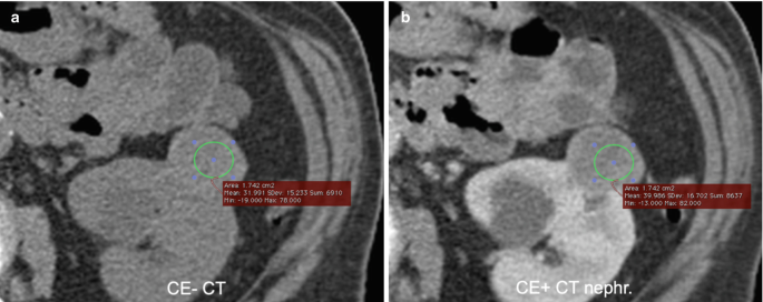 2 C T scans of cancerous regions in the left kidney. The cancerous regions are highlighted and marked for their area. The tumor appears bright and in an irregular trilobed shape.