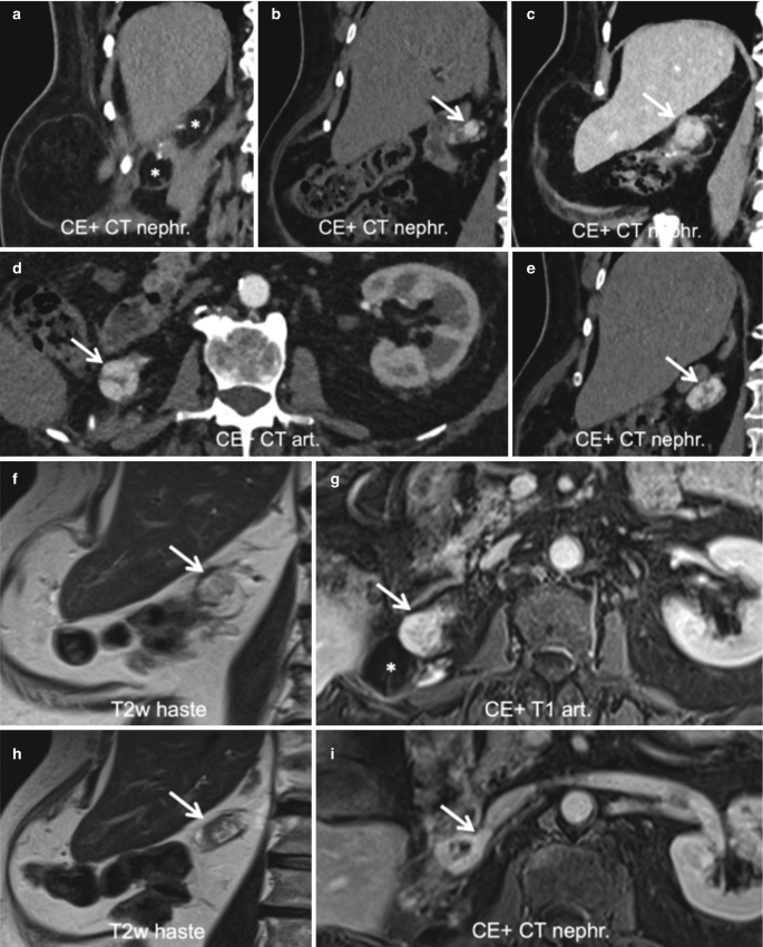 5 C T and 4 M R I scans illustrate a tumor in the right kidney. The tumor starts as a small irregular and bright structure marked by arrows. The tumor size gets bigger in subsequent scans illustrating recurrence.