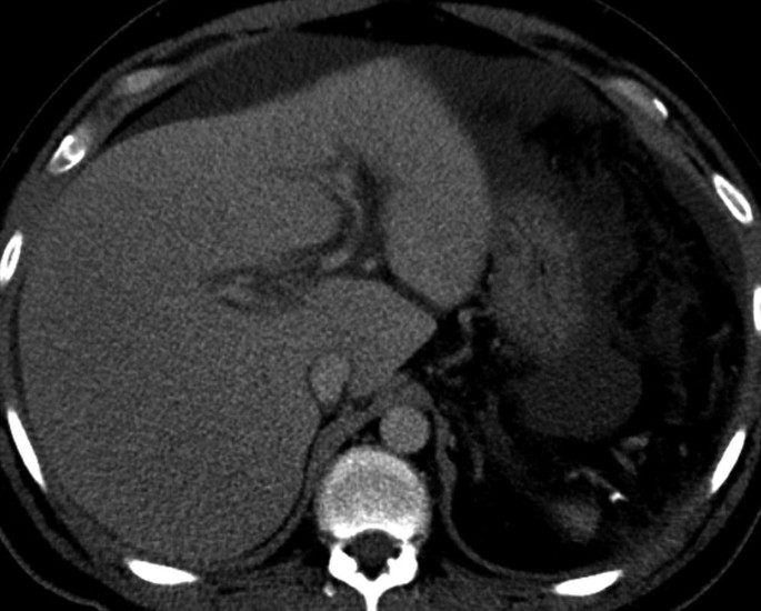 A C T scan of the patient with hepatitis demonstrates the periportal edema on the left. Some bright parts can be seen near the boundary wall.