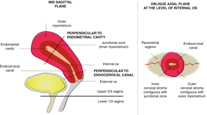 A chart presents 2 schematic diagrams of the uterine corpus and cervix. The diagram on the left is labeled mid-sagittal plane and labels 6 parts. The diagram on the right is titled, the oblique axial plane at the level of internal O S. It labels the parametrial regions, the endocervical canal, the inner cervical stroma contiguous with the junctional zone, and the outer cervical stroma contiguous with the outer myometrium.