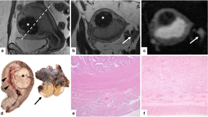 5 scan images and a photo. A to C depicts the endometrial cavity is filled with a polypoid mass, that seems dark in color. D. The photo of the 2 surgical specimens. E and F. The histopathology images demonstrate the endometrial serous carcinoma.