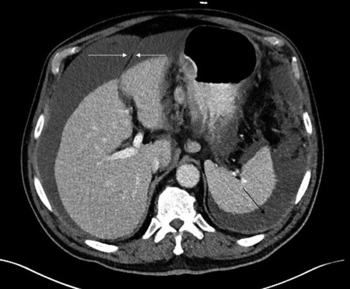 A C T image of the axial view of the abdomen highlights the fluid surrounding the spleen.