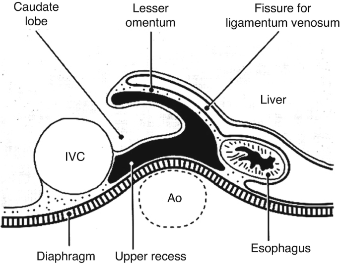 A diagrammatic representation with the labels, caudate lobe, lesser omentum, fissure for ligamentum venosum, liver, esophagus, upper recess, diaphragm, I V C, and A o.