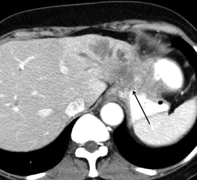 A C T image of the axial view of the abdomen with an arrow highlights the inflammation on the right.