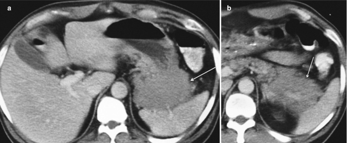 Two C T images of the axial section of the abdomen highlight the tumor in the splenic helium.
