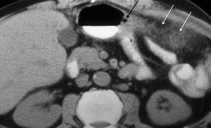 A C T image of the axial view of the abdomen has arrows pointing to the enhancement of dark spots.