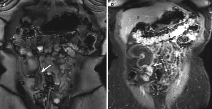 Two M R-E images of the abdomen with small circular patches of various sizes and arrows pointing to the bowel dilatation in the terminal ileum.