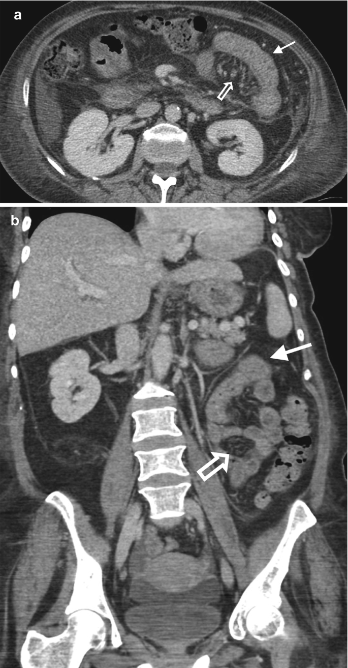 Two C T images of an axial and coronal section of the abdomen with arrows pointing to the thickened bowel wall. In A, the light bean-shaped cells, and in B, the stacked and pelvic bones in light shade are highlighted.