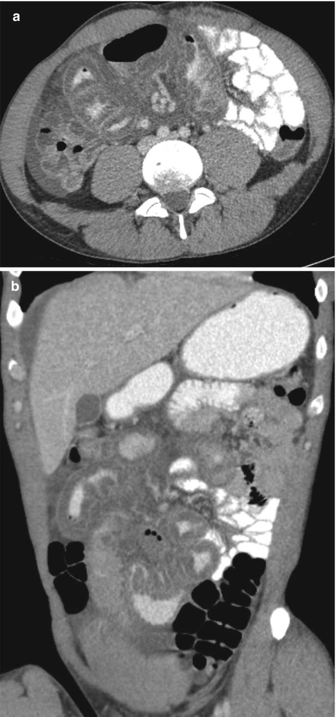 Two C T images of the axial and coronal section of the abdomen highlight the infectious gastroenteritis. It indicates the dark and light rounded patches clustered in different sizes.
