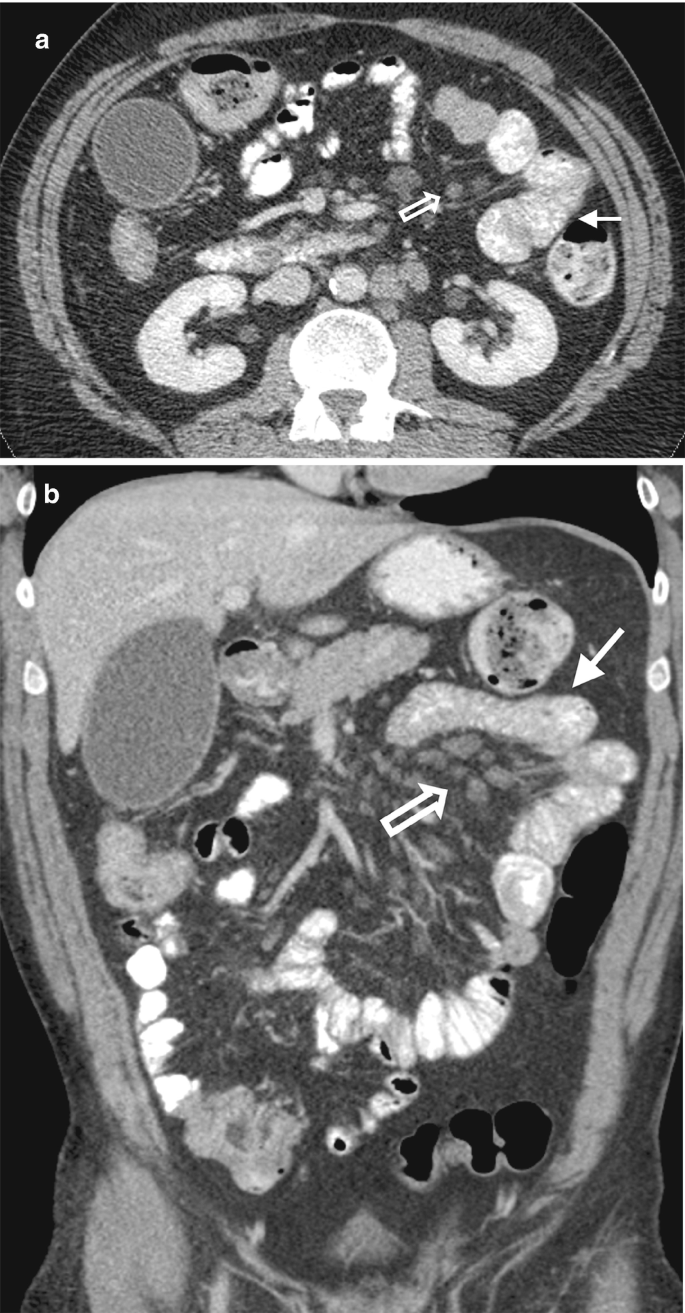 Two C T images of the axial and coronal section of the abdomen with arrows pointing to jejunal folds. It consists of dark and light circular spots of various sizes. Two bean-shaped cells are indicated in image A.