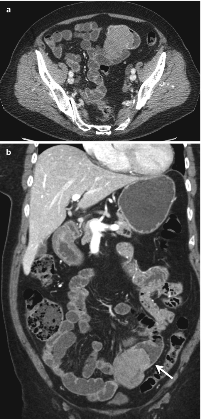 Two C T images of the axial and coronal section of the abdomen with arrows pointing to proximal bowel dilatation. The abdomen is filled with fluid lesions, and creamy patches of various sizes are highlighted.