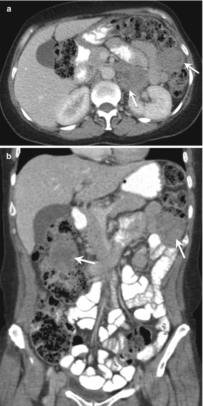 Two C T images of the axial and coronal section of the abdomen with an arrow pointing to small bowel masses. The bowel with light clustered patches is marginated, and the dark spots are highlighted.