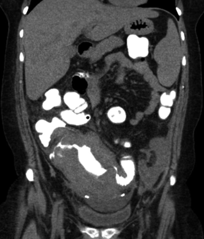 A C T image of the coronal section of the abdomen focusing on the thickening of the bowel wall. The light circular patches in different sizes are highlighted.