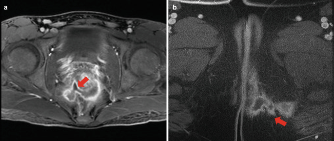 Two M R I of the lower abdomen highlight the perianal abscess in the ischiorectal fossa.