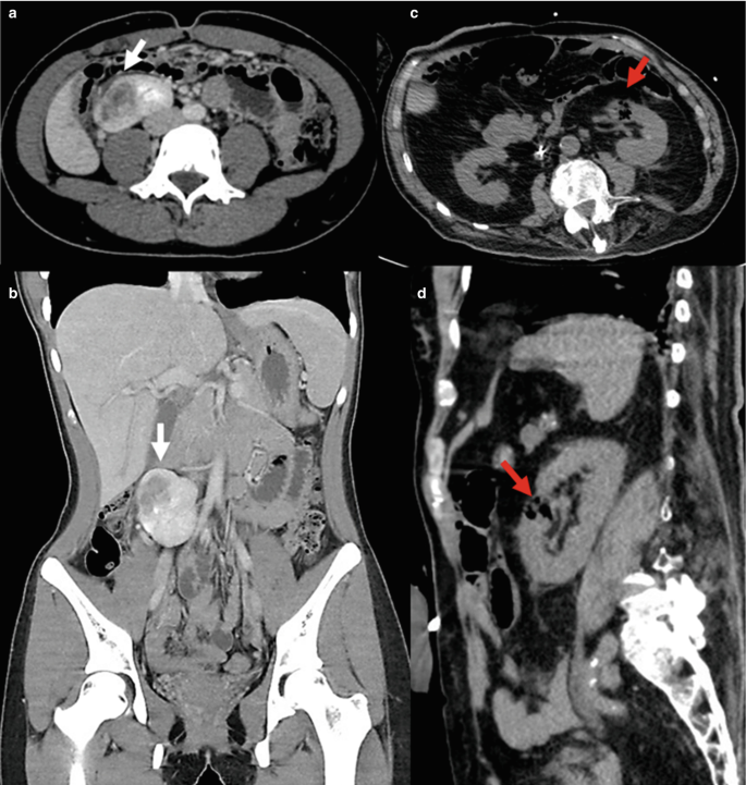 Four M R I of the 2 axial and 2 coronal sections of the abdomen. Arrows highlight the renal abscess. It enhances the light patch at the bottom of the images.