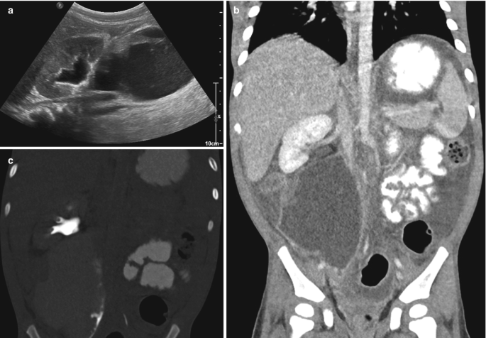 A sagittal ultrasound and 2 C T scans illustrate renal rupture and urinoma. The ultrasound indicates an area centrally located with a homogenous dark shade appearing as fluid content. The C T scans with dark and light rounded patches depict the same.