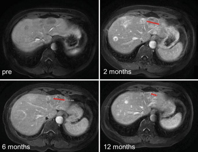 4 axial contrast M R I marked as pre, 2, 6, and 12 months. The 4 scans illustrate an increase and further decrease in tumor mass between them. A line marks the diameter of the tumor and illustrates the size reduction between 2, 6, and 12 months.