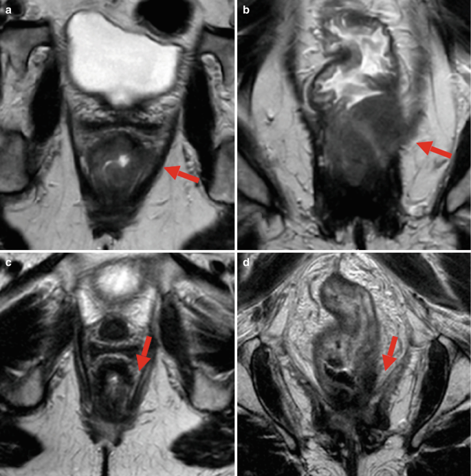 4 axial and coronal M R I scanned images indicate a tumor in the lower rectal area marked by arrows. The tumor appears near the levator region and is in an irregular shape.