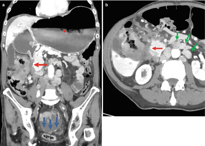 2 coronal and axial C T scans of abdominal regions. The colon has bright irregular lesions on the left regions of the scans marked by arrows. Arrows also point to the cancerous areas in the pelvic regions.