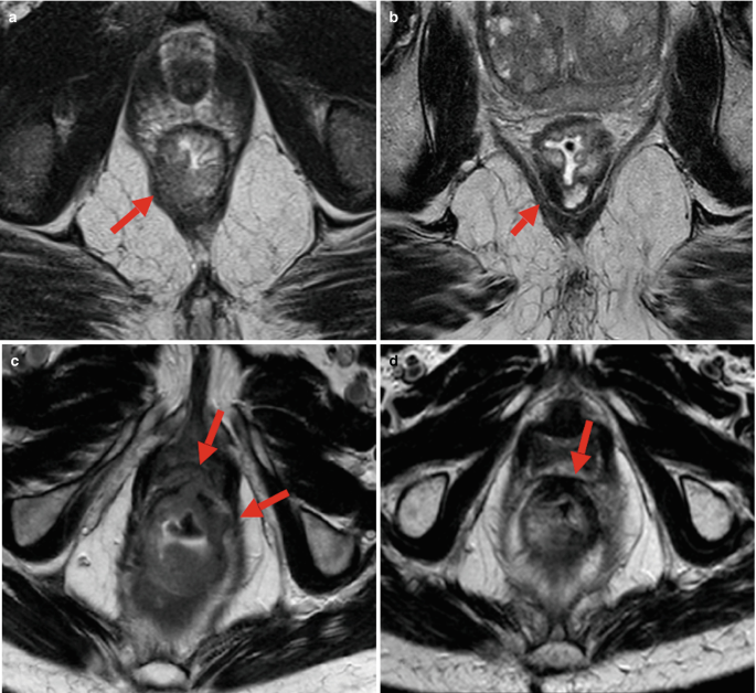 4 M R I scans of the lower rectal area of the abdomen. The scans have arrows pointing to the right portion of the levator, a thin plane to the right of the levator, left of the levator, and the upper part of the levator.