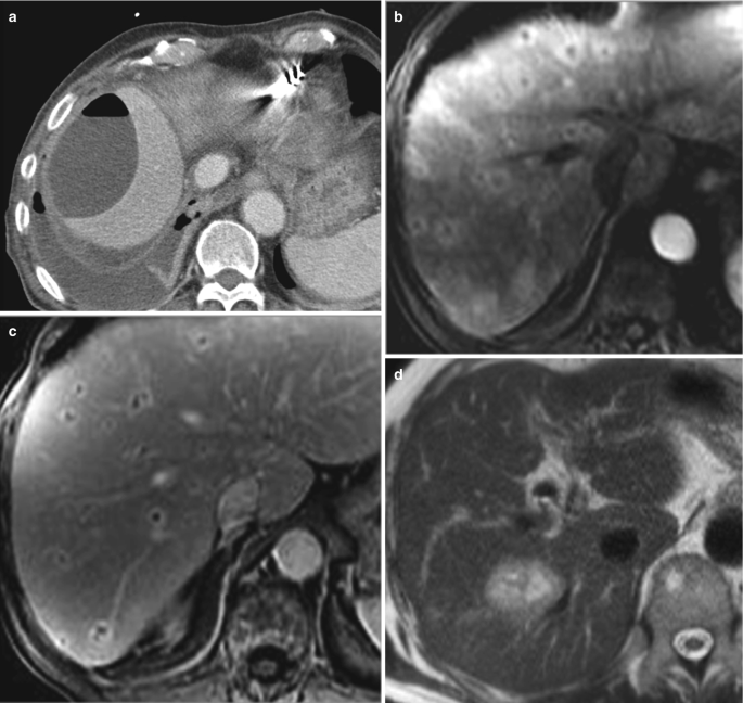 6 M R I scans of the liver with swollen bumps and lesions of different sizes. It is circular and appears on the left side of the scan. The second and third scans have small lesions dispersed all over. The fourth, fifth, and sixth scans have infections on the right hepatic lobe illustrating lesions in the biliary tract region.