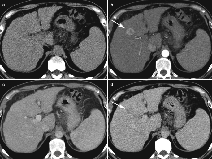4 M R I images illustrate liver cirrhosis. The right part of the scans indicate an enlargement in the spleen. Arrows point to the upper left part of the scan pointing to lesions appearing in bright circular shape.
