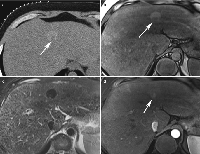 4 M R I scans of the liver with arrows pointing to a nodule-like circular mass on the upper part. The area marked by arrows appears brighter than the peripheral areas.