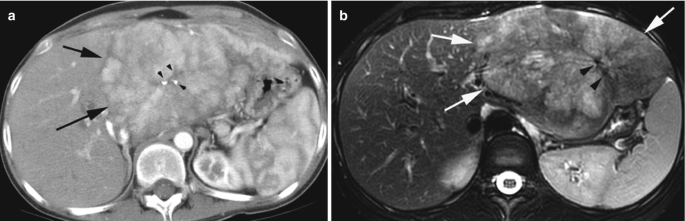 2 M R I scans of the liver with a large mass on the left lobe. Arrows point to the large mass on the left lobe illustrating scars and calcifications.