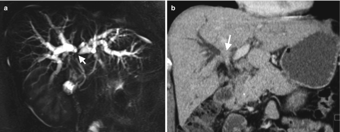 A M R I and a C T scan illustrate the liver with dilated right and left intrahepatic ducts appearing brighter in the first scan. The C T scan with an arrow pointing to the darkly stained intrahepatic ducts.