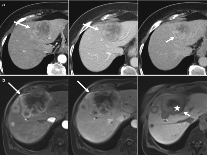 A 2-part illustration. 3 C T and 3 M R I scanned images marked a and b. The C T scans illustrate a tumor-like growth in the liver towards the upper part marked by arrows. The M R I scans indicate the tumor-like mass with a thick irregular appearance on the upper part of the liver marked by arrows.