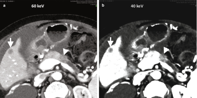 2 C T images. The arrow indicates the location of the tumor, and the head arrow indicates the extent of its spread in the liver. The image taken at 40-kilo electron volts is clearer than the one taken at 60-kilo electron volts.