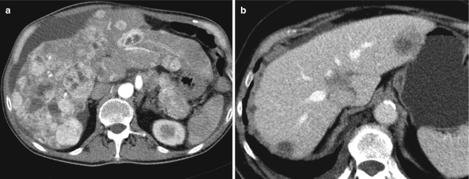 2 C T scans of the liver with multiple tumorous masses scattered inside the liver. The metastatic mass appears bright and irregularly arranged circular structures clustered inside the liver.