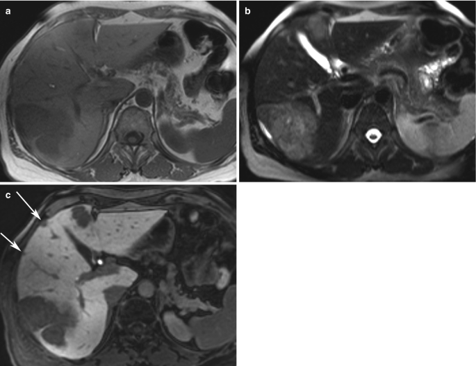 3 M R I scans of the liver and peripheral regions. The liver has a tumor-like structure in the lower right part. The third scan with higher contrast points out 2 metastatic regions marked by arrows to the right of the liver.