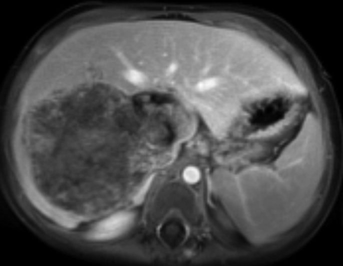 A M R I scan of the liver. The liver illustrates metastasis on the left part of the scan. The metastasis appears dark and irregularly rounded on the left than the rest of the liver.