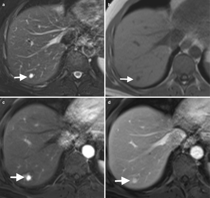 6 M R I images of the liver. The arrow marks a lesion that appears as a tiny dot in bright and dark shades in different scans on the left bottom.