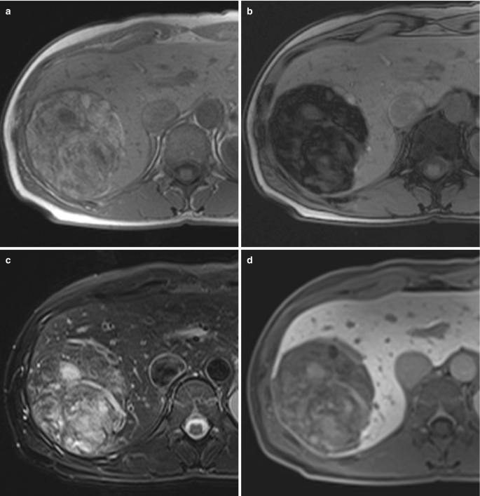 4 M R I images of the liver with the enhancement of circular mass on the left. Two small rounded patches at the center with a distribution of dark spots are exposed.