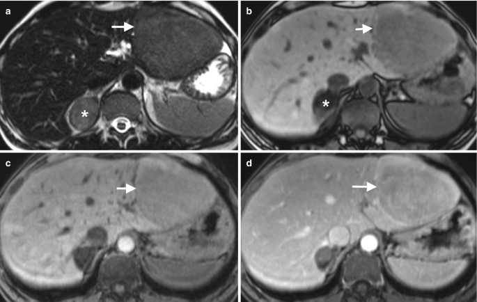 4 M R I images of the liver with a circular mass of lesions on the right are marked by arrows. The lower part of the liver in the first 2 scans illustrates a mass on the adrenal region.