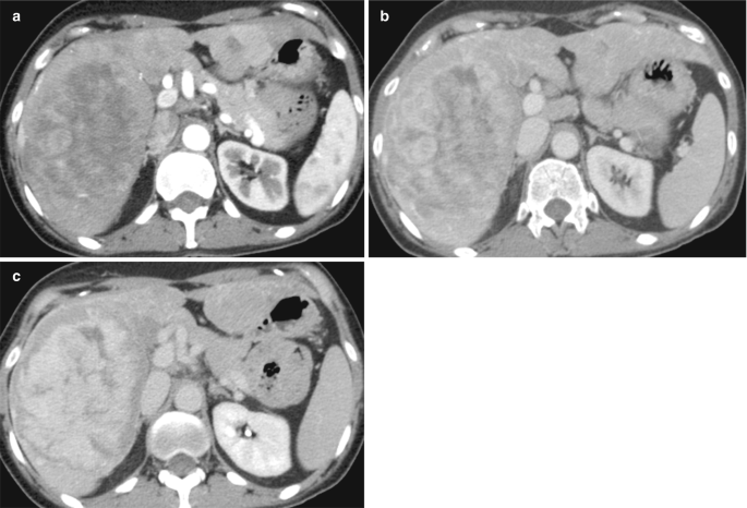 3 C T images of the liver with the enhancement of irregular mass filled with lesions on the top right. The liver indicates fragments of light-shaded patches with inflammation.