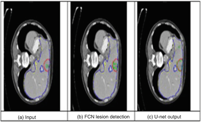 Three C T scans of the liver with light and dark shades. a is input. b is F C N lesion detection. c is U-net output. They are marked with 3 different colors.