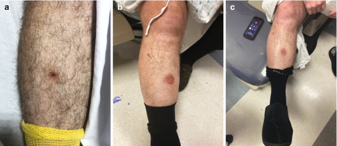 Scars on Thighs from Picking Fig. 2: Scars on Lower Limb from Picking