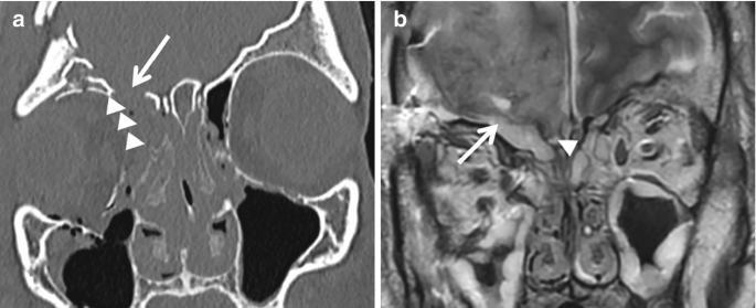 A set of 2 scans of the nasal area labeled a and b. The scans have arrows and arrowheads that point to the defective areas.