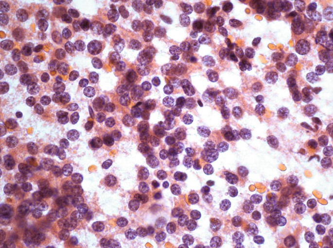 A microscopic slide with P D T C morphology represents aspirates with predominant isolated cells with granular chromatin, mimicking both medullary thyroid carcinoma and metastatic neoplasms.