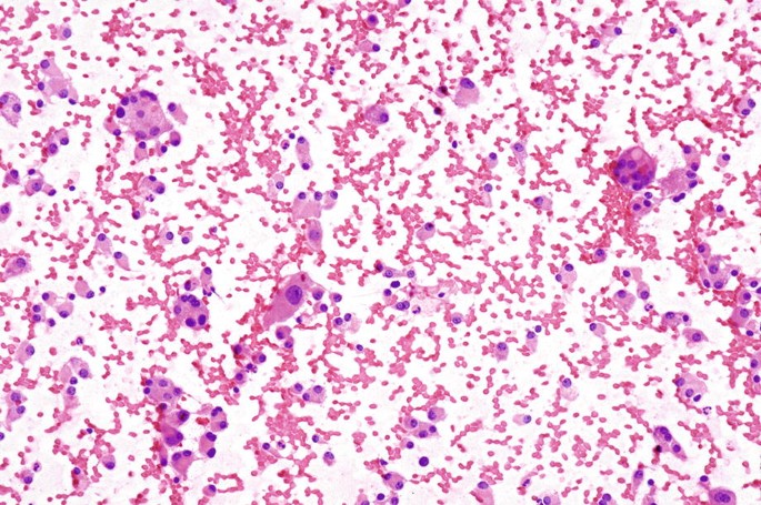 A hematoxylin and eosin stain image of irregularly-shaped clusters of oncocytic follicular cells without polymorphous lymphocytes.