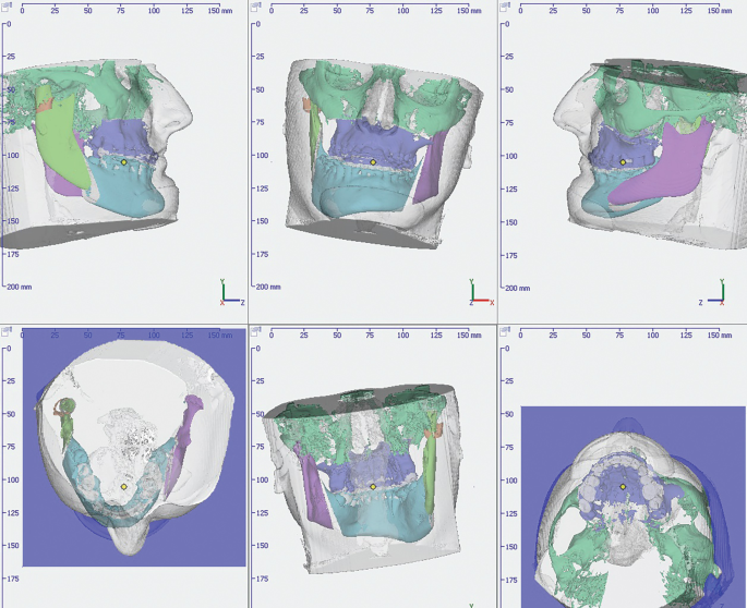 Six 3-D skull-less models of the left side of the skeletal structure of the face, front side, right side, maxillary teeth, back side of the jaws, and mandibular teeth. Each model is overlayed with the outline of the fleshy facial structure.