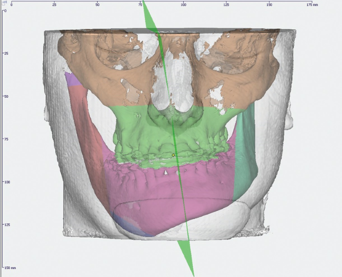 A 3-D skull-less model of the facial outline of a person overlayed with the skeletal structure consisting of right-sided hemifacial hypertrophy. The chin is segmented with an outline.