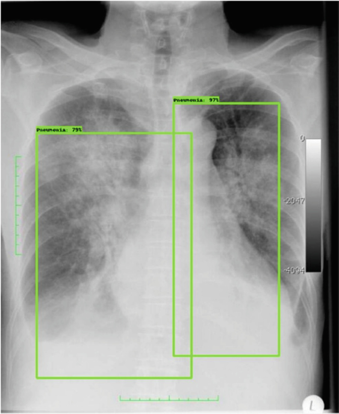 A radiograph of the opaque lungs indicates infection or inflammation. The size and location of the affected areas may classify pneumonia in the left lung at 79 percent and the right lung at 97 percent.