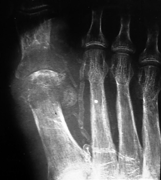 Osteochondroma-Related Pressure Erosions in Bony Rings Below the Waist