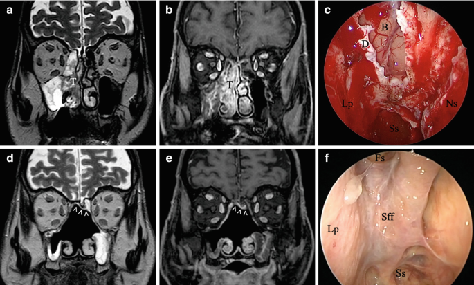 A and B are M R I of the nasal structure with carcinoma development. C is the endoscopy image of the nasal region. D and E depict the radiotherapy follow-up structure. F is the endoscopy after radiotherapy with parts labeled for L p, S F F, S S, and F S.